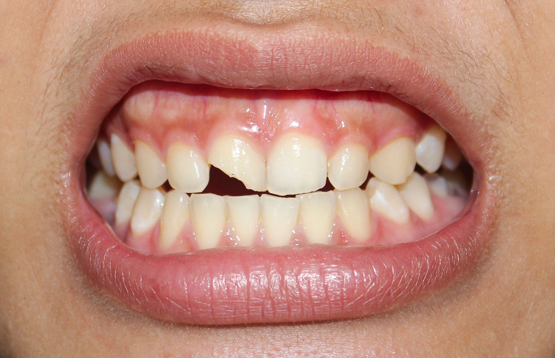 AdobeStock 1522443619 1 - Cedar Pearl Dental
